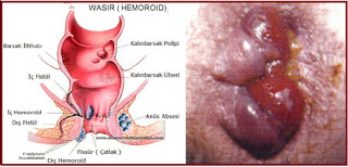 Illustration for article titled obat ambeien cepat sembuh